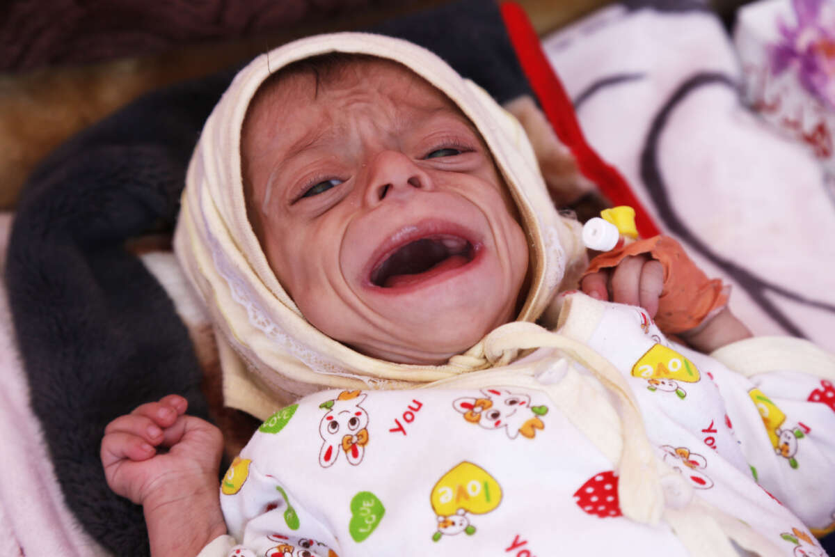 A Yemeni baby, suffering from malnutrition, receives treatment with limited resources in the Department of Combating Malnutrition at Sabeen Hospital in Sanaa, Yemen, on March 1, 2023.