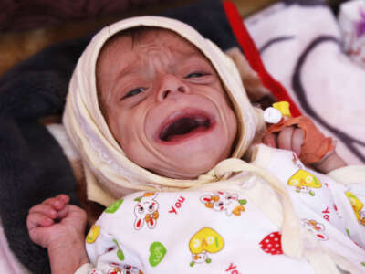 A Yemeni baby, suffering from malnutrition, receives treatment with limited resources in the Department of Combating Malnutrition at Sabeen Hospital in Sanaa, Yemen, on March 1, 2023.