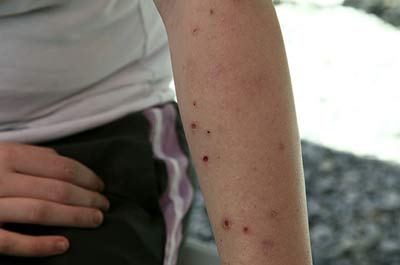 Skin lesions like this have become common in the impact zone of BP's 2010 oil disaster in the Gulf of Mexico. (Photo: Erika Blumenfeld / Al Jazeera)