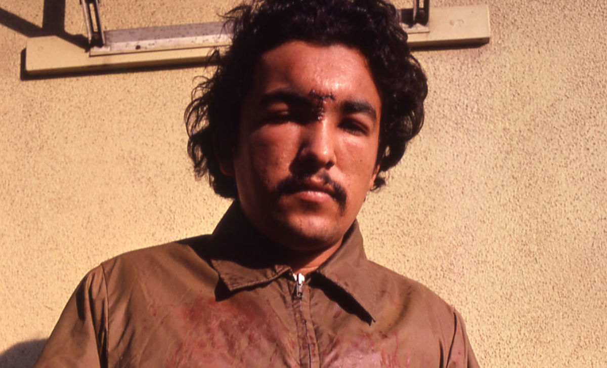 This photo of the author was taken three days after he was attacked by Los Angeles Sheriff’s deputies on March 23, 1979.