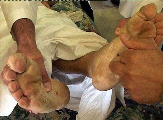 Zoman's feet had point-burn marks from electrical shocks on the bottoms of his feet and genitals. (Photo: Dahr Jamail)
